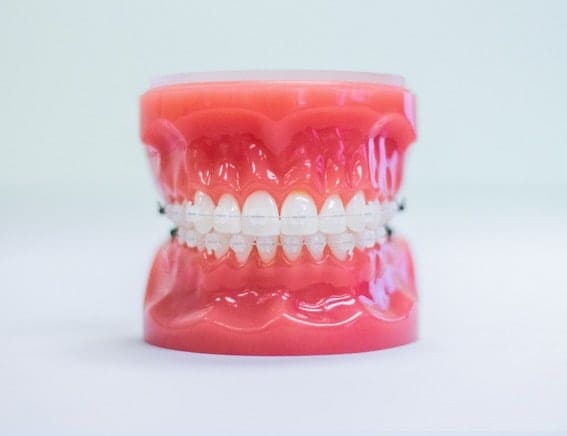clear braces on plastic model
